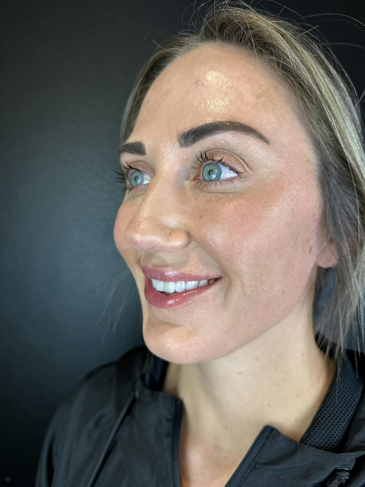 Wrinkle Relaxer Before & After Gallery - Patient 110000 - Image 2