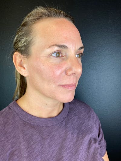 Sculptra Before & After Gallery - Patient 384752 - Image 1