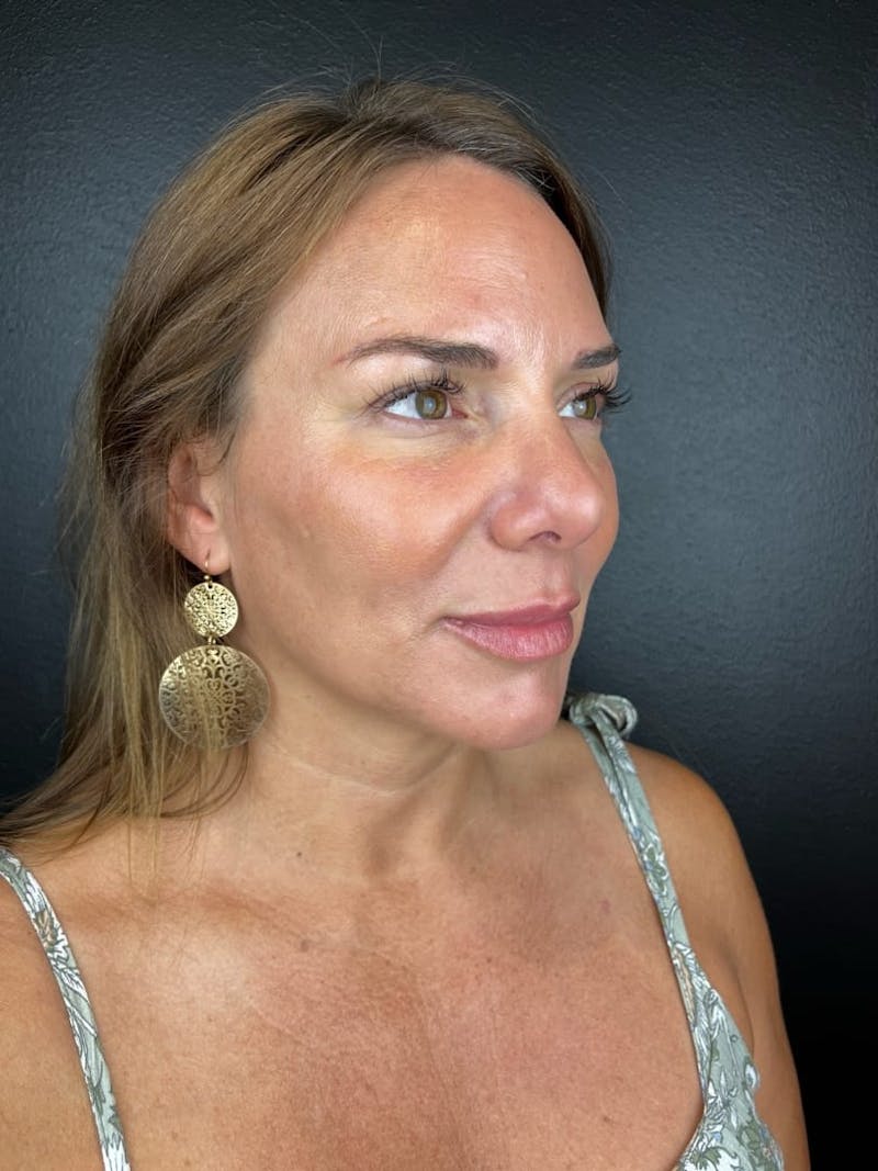 Sculptra Before & After Gallery - Patient 384752 - Image 2