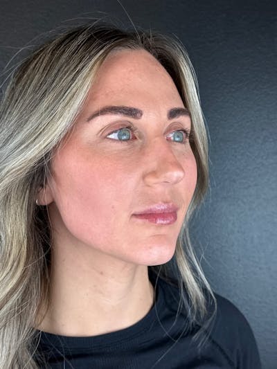 Sculptra Before & After Gallery - Patient 167027 - Image 1