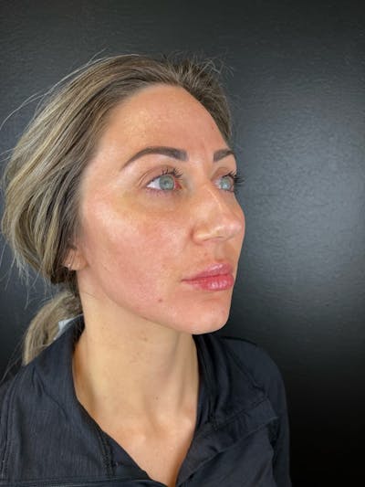 Sculptra Before & After Gallery - Patient 167027 - Image 2