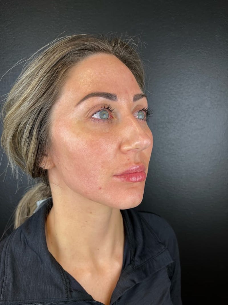 Sculptra Before & After Gallery - Patient 167027 - Image 2