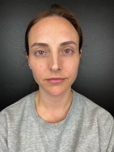 RF Microneedling Before & After Gallery - Patient 247971 - Image 2