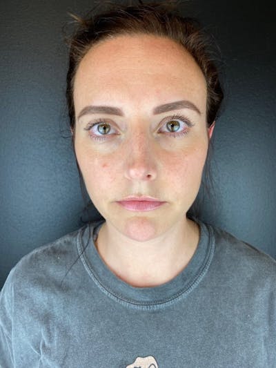 RF Microneedling Before & After Gallery - Patient 247971 - Image 1