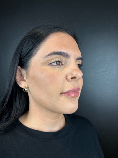 RF Microneedling Before & After Gallery - Patient 268027 - Image 2
