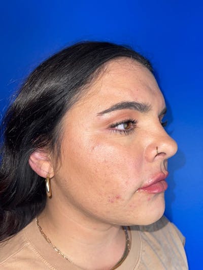 RF Microneedling Before & After Gallery - Patient 268027 - Image 1