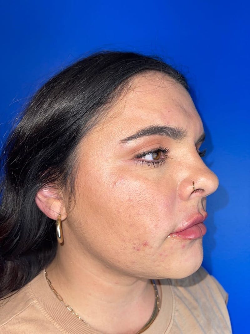 RF Microneedling Before & After Gallery - Patient 268027 - Image 1