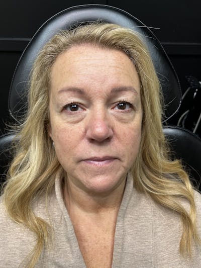 Peko SELF Before & After Gallery - Patient 303418 - Image 1