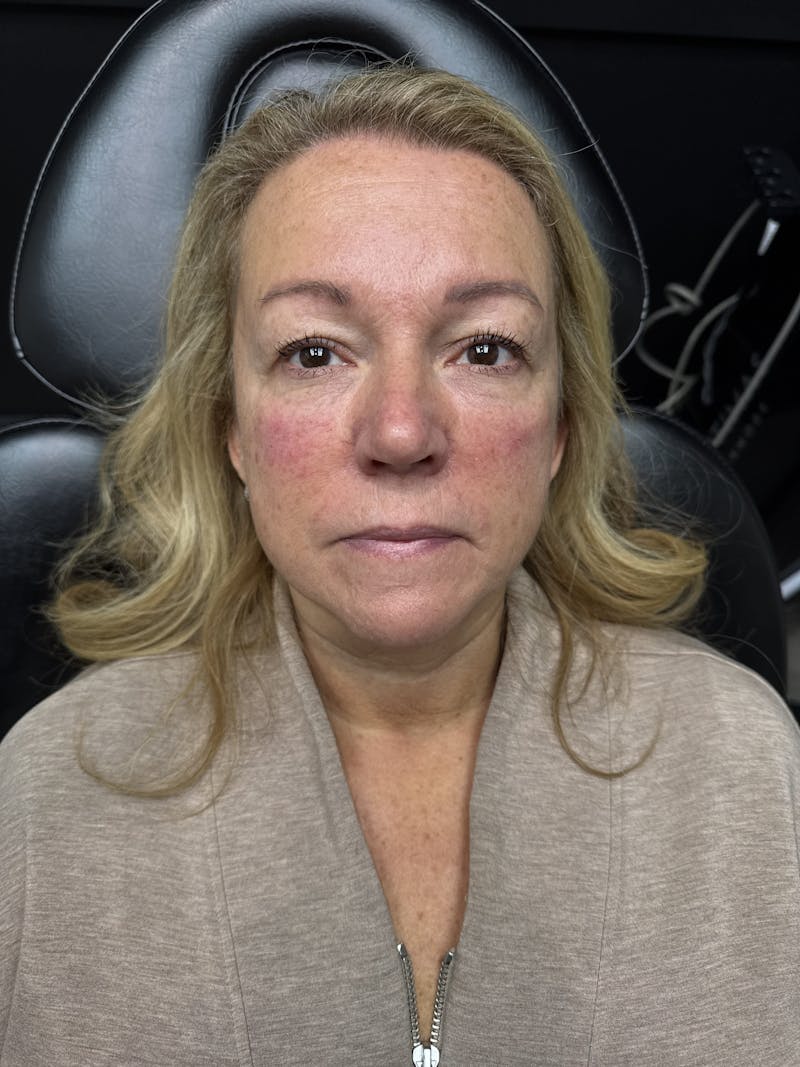 Peko SELF Before & After Gallery - Patient 303418 - Image 2