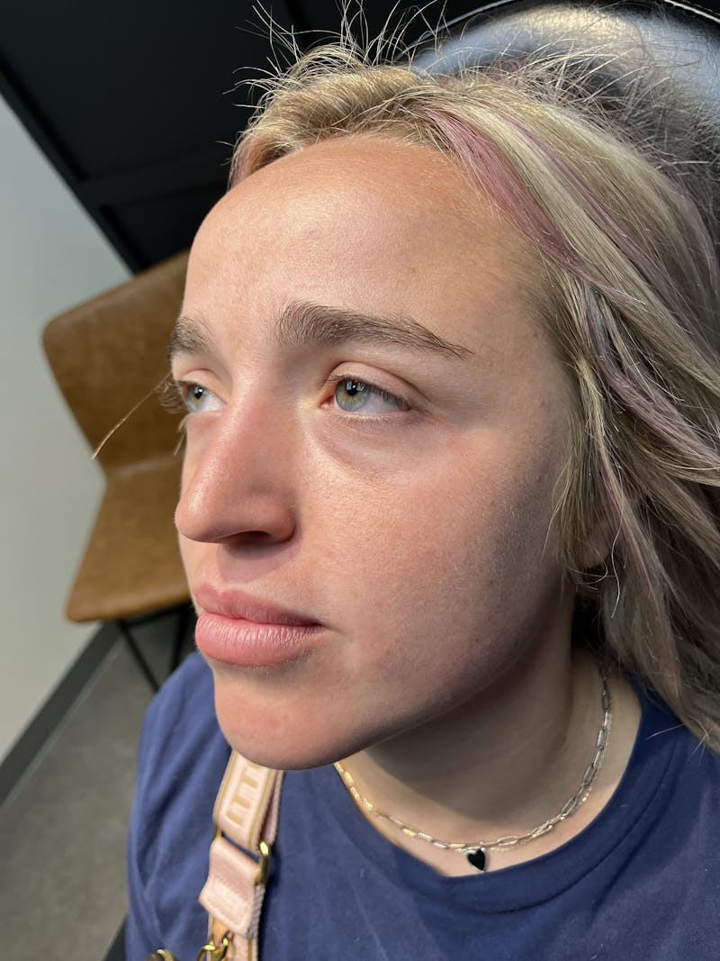 Peko SELF Before & After Gallery - Patient 873710 - Image 1
