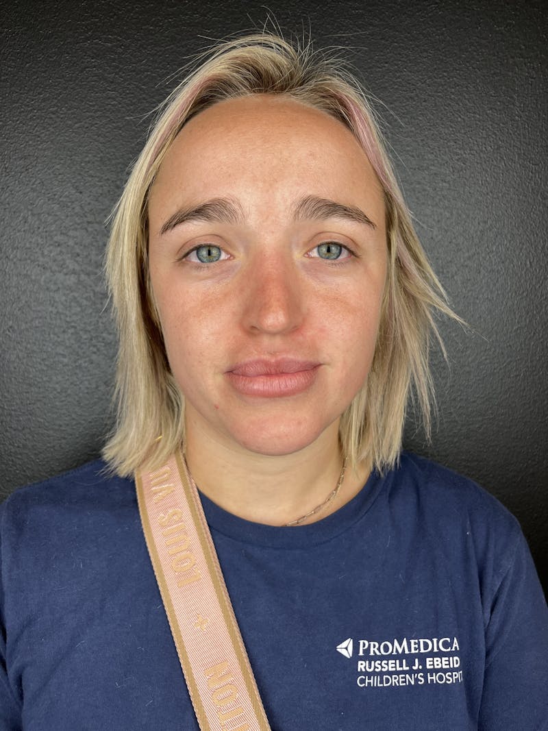 Peko SELF Before & After Gallery - Patient 873710 - Image 3