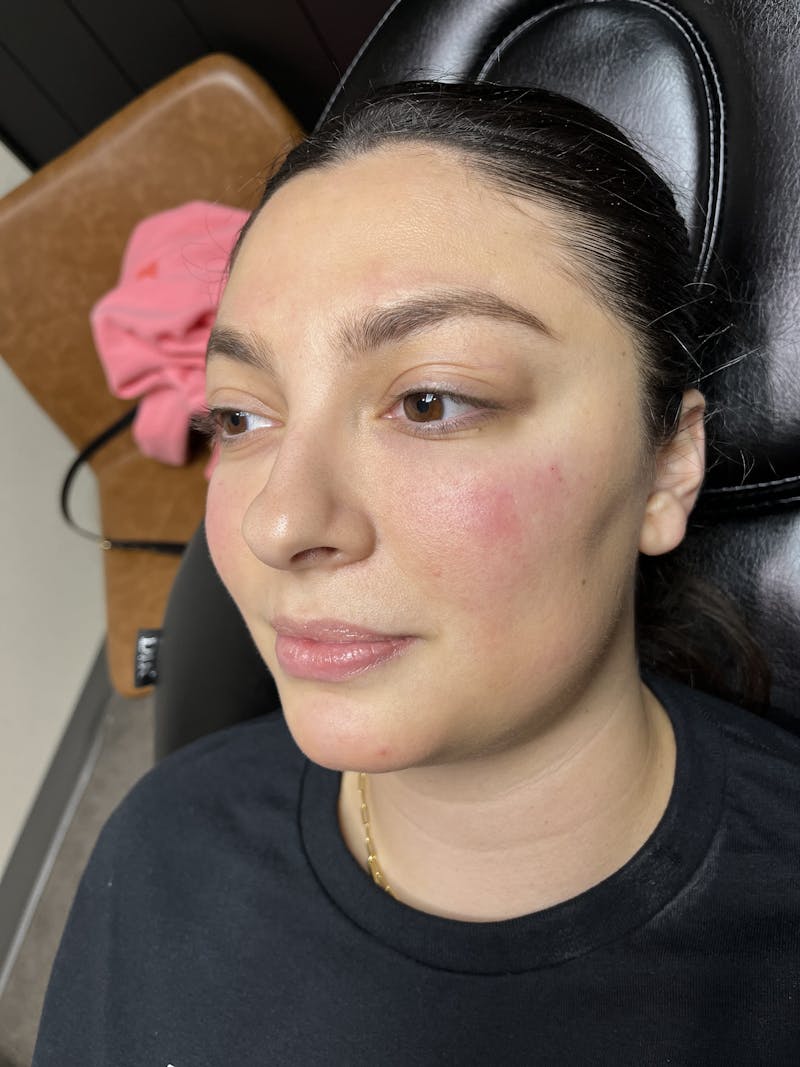 Peko SELF Before & After Gallery - Patient 299198 - Image 2