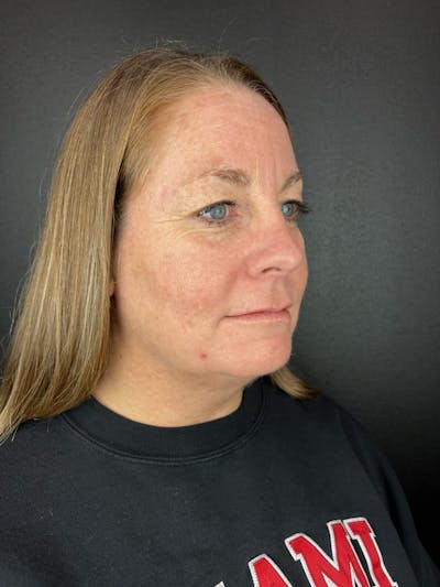 IPL Before & After Gallery - Patient 413800 - Image 2