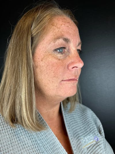 IPL Before & After Gallery - Patient 413800 - Image 1
