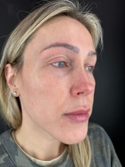 IPL Before & After Gallery - Patient 366034 - Image 2