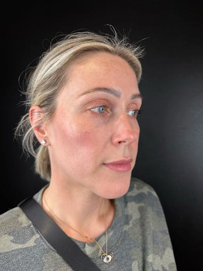 IPL Before & After Gallery - Patient 366034 - Image 1