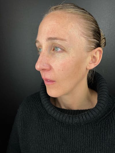 IPL Before & After Gallery - Patient 117629 - Image 2