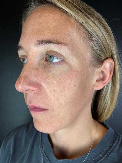 IPL Before & After Gallery - Patient 117629 - Image 1