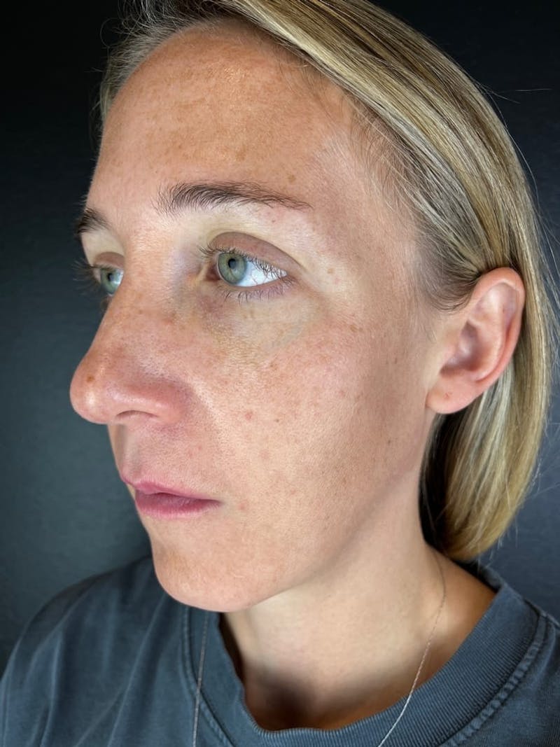 IPL Before & After Gallery - Patient 117629 - Image 1
