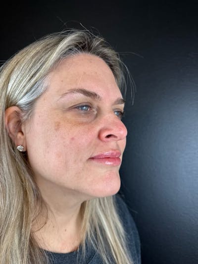 IPL Before & After Gallery - Patient 398682 - Image 1