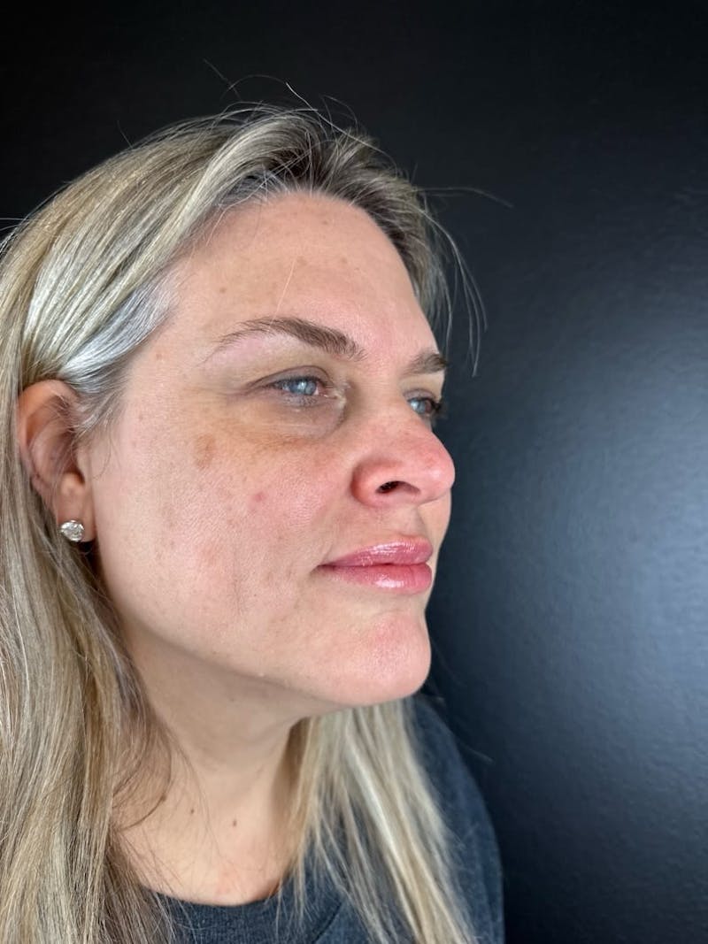 IPL Before & After Gallery - Patient 398682 - Image 1