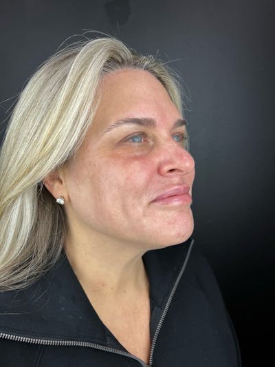 IPL Before & After Gallery - Patient 398682 - Image 2