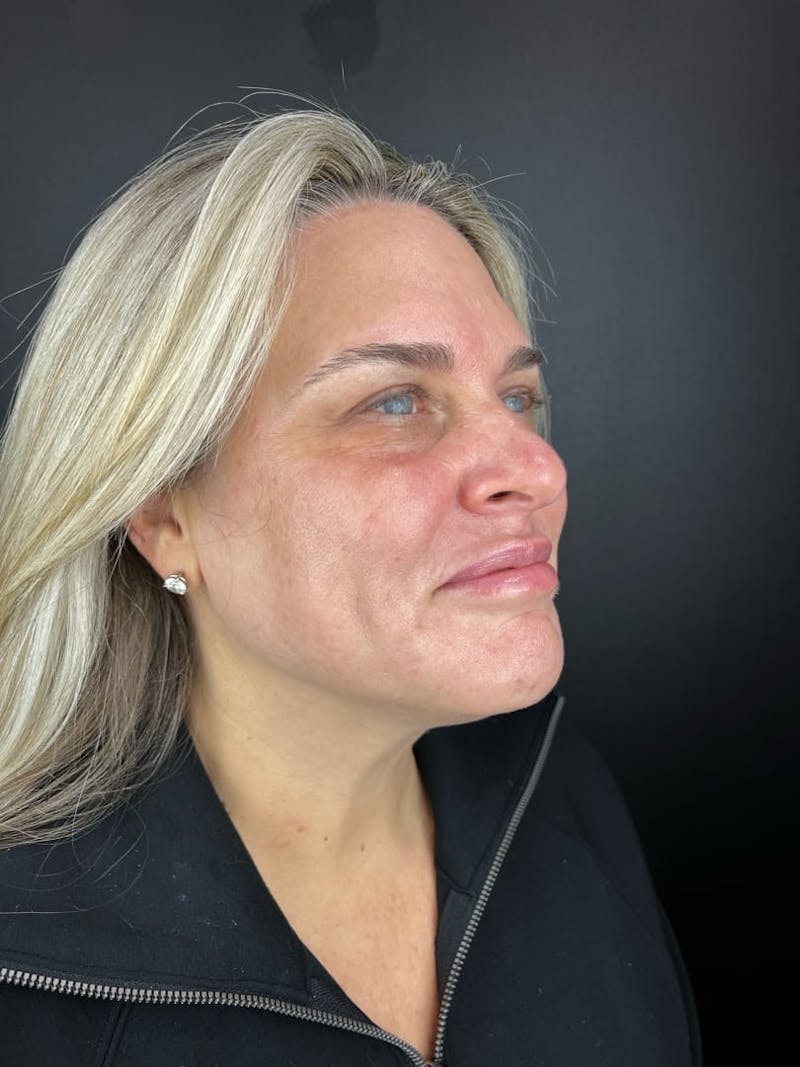 IPL Before & After Gallery - Patient 398682 - Image 2