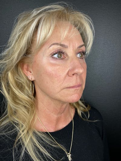 IPL Before & After Gallery - Patient 122314 - Image 2