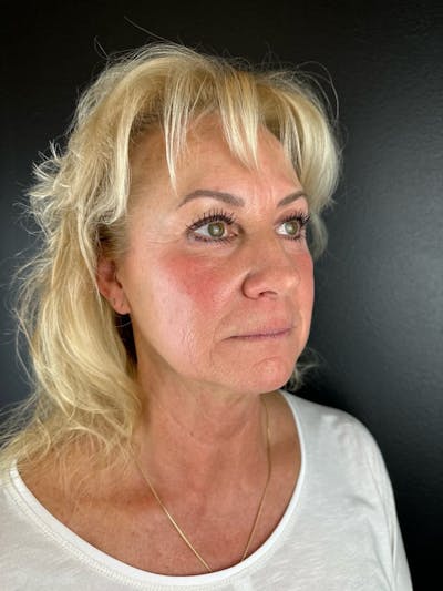 IPL Before & After Gallery - Patient 122314 - Image 1