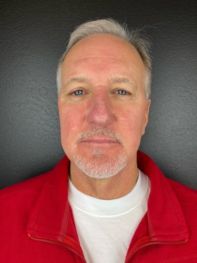 IPL Before & After Gallery - Patient 137235 - Image 2