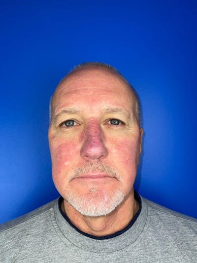 IPL Before & After Gallery - Patient 137235 - Image 1
