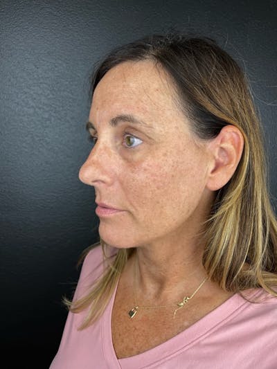 IPL Before & After Gallery - Patient 104796 - Image 1