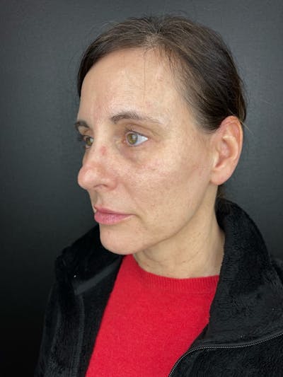 IPL Before & After Gallery - Patient 104796 - Image 2