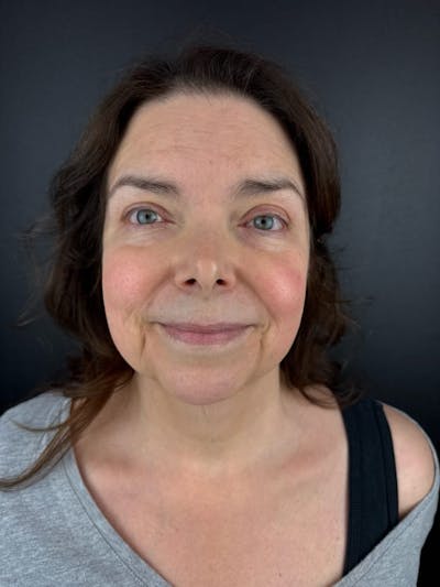 IPL Before & After Gallery - Patient 323824 - Image 2