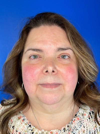 IPL Before & After Gallery - Patient 323824 - Image 1