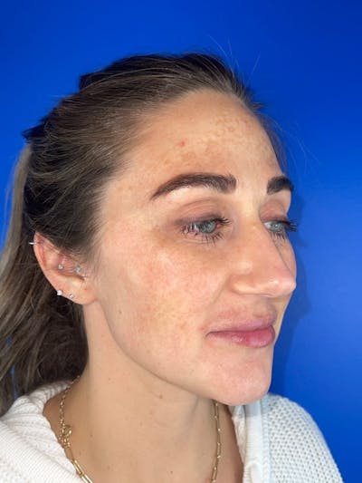IPL Before & After Gallery - Patient 195988 - Image 1