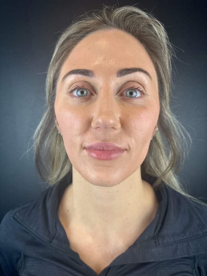 IPL Before & After Gallery - Patient 195988 - Image 4