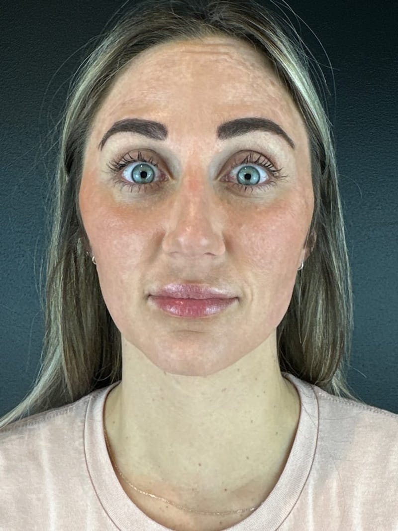 IPL Before & After Gallery - Patient 195988 - Image 3