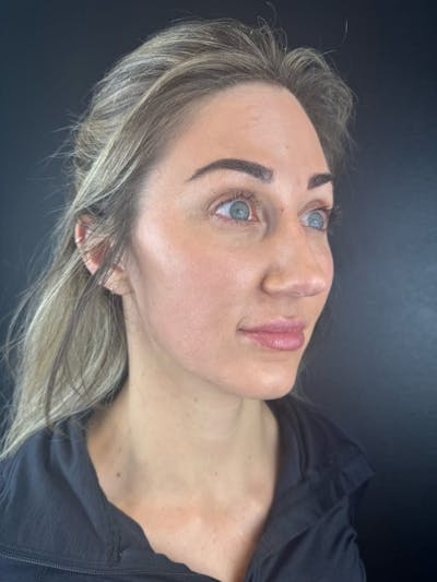 IPL Before & After Gallery - Patient 195988 - Image 2