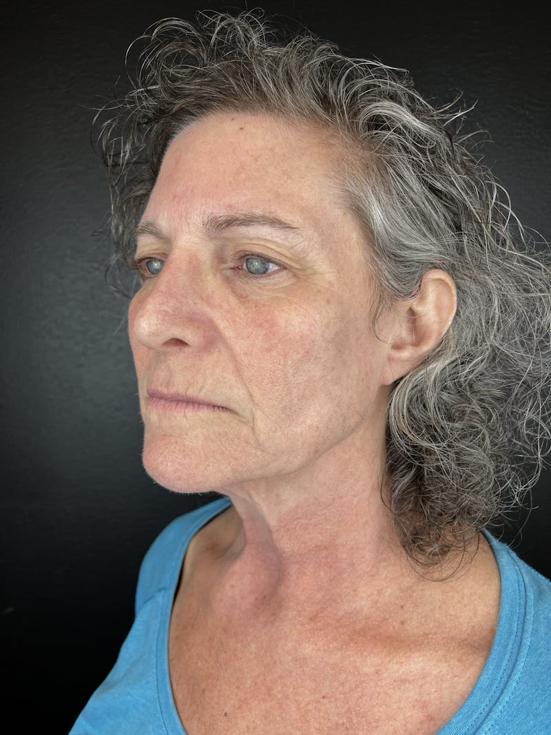 Comprehensive Treatment Plans Before & After Gallery - Patient 343538 - Image 4