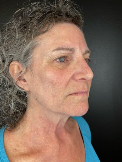 Comprehensive Treatment Plans Before & After Gallery - Patient 343538 - Image 2