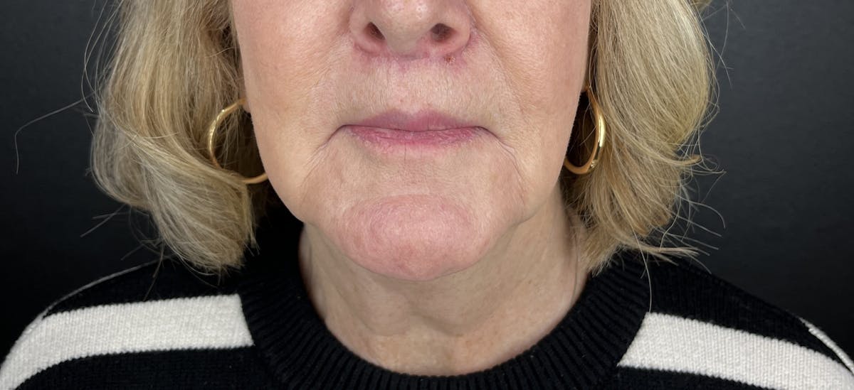 Lower Face Filler Before & After Gallery - Patient 328542 - Image 2