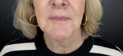 Lower Face Filler Before & After Gallery - Patient 328542 - Image 2