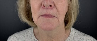 Lower Face Filler Before & After Gallery - Patient 328542 - Image 1