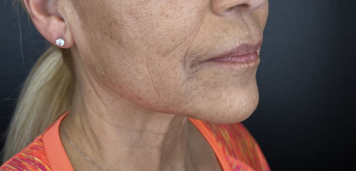 Lower Face Filler Before & After Gallery - Patient 350153 - Image 2