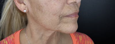 Lower Face Filler Before & After Gallery - Patient 350153 - Image 1