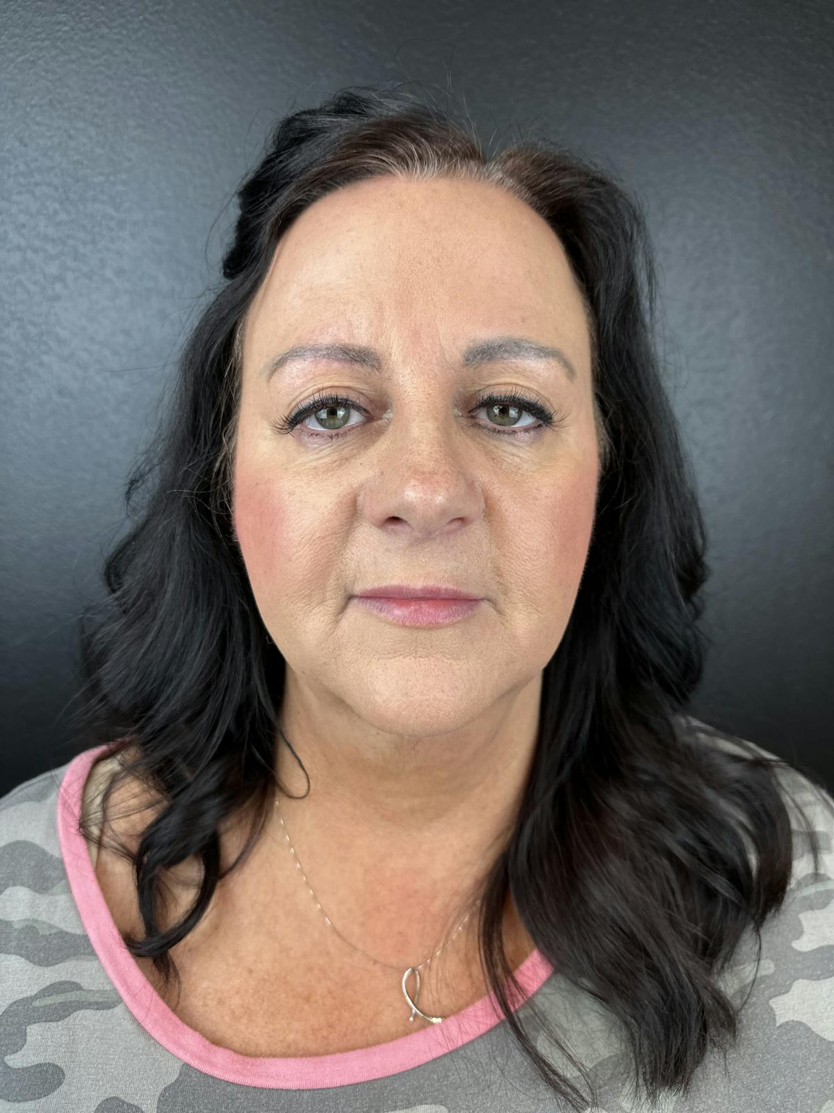 Lower Face Filler Before & After Gallery - Patient 317946 - Image 2
