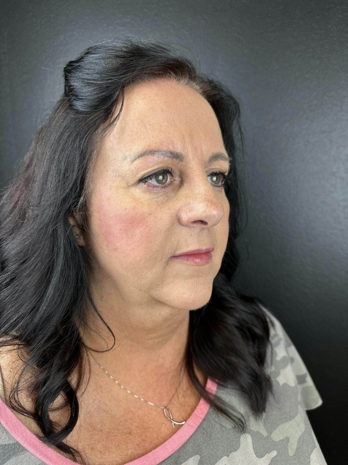 Lower Face Filler Before & After Gallery - Patient 317946 - Image 4