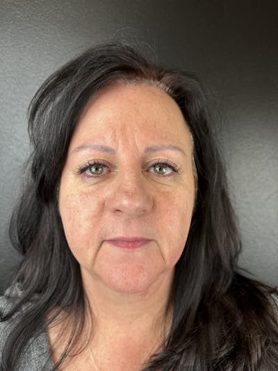 Lower Face Filler Before & After Gallery - Patient 317946 - Image 1
