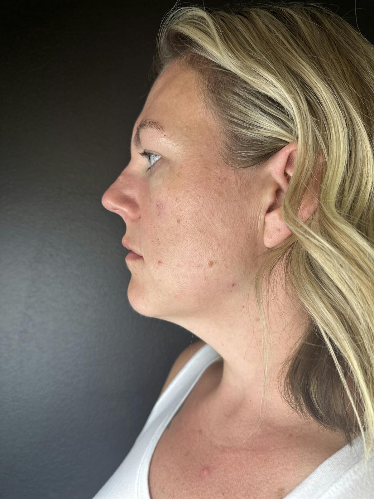 Lower Face Filler Before & After Gallery - Patient 370798 - Image 2